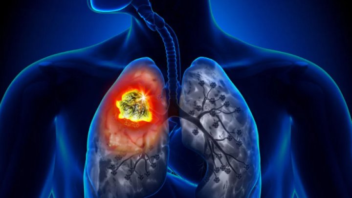 Ağciyər Xərçəngi Müalicəsində Yeni ümid: Alimlərdən Sensasiyalı Kəşf!