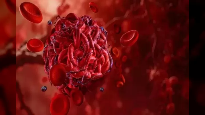 Trombdan şübhələnirsiniz? əsas Narahatlıq əlamətləri Və Risk Faktorları